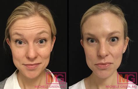Can Botox cause eyebrow hair loss?