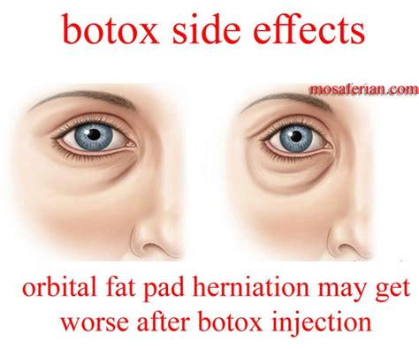 Can Botox cause mental issues?