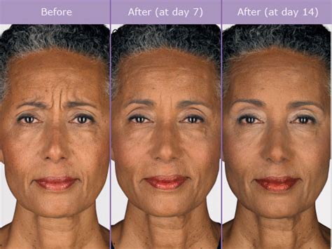 Can Botox cause mood changes?
