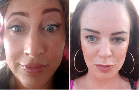 Can Botox go wrong in forehead?