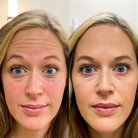 Can Botox look weird at first?