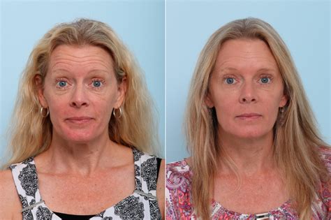 Can Botox make wrinkles worse?