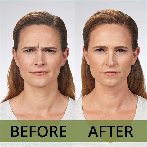 Can Botox reverse wrinkles?