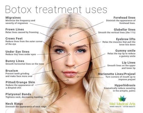 Can Botox soften 11 lines?