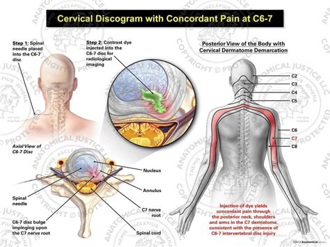 Can C5 C6 cause headaches?