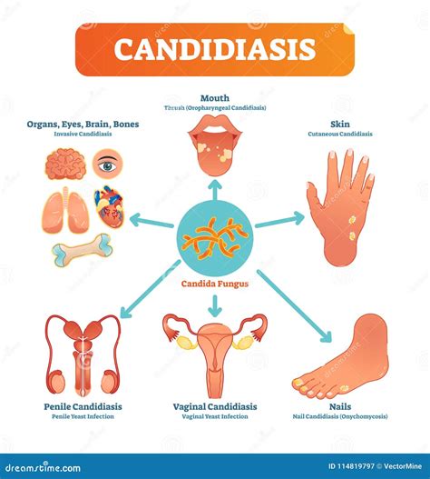 Can Candida live on sheets?