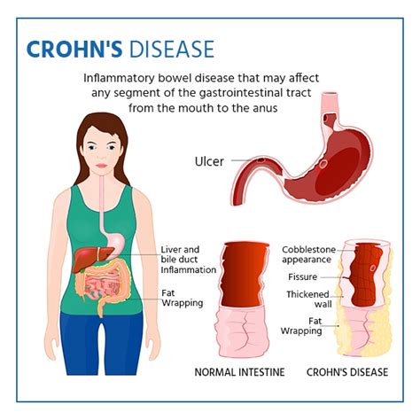 Can Crohn's be cured?