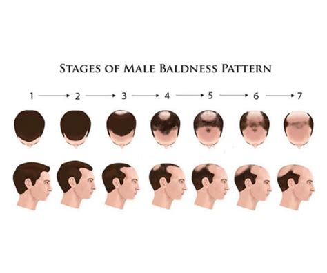 Can DHT baldness be reversed?