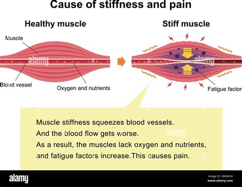 Can EDS cause muscle stiffness?