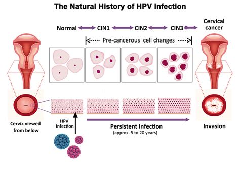 Can HPV clear in 3 months?