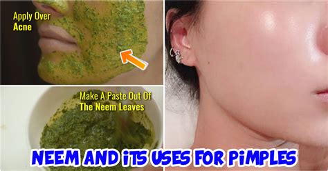 Can I apply neem directly on skin?