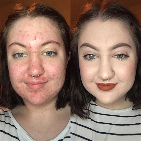Can I cover my acne with makeup?