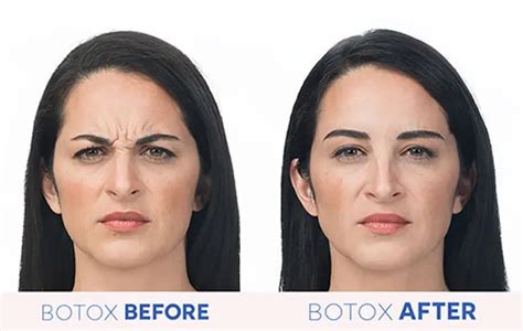 Can I do smoothening after Botox?