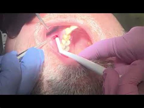 Can I drain a gum abscess with a needle?