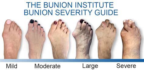 Can I get disability for bunions?
