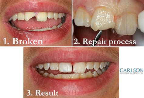 Can I glue a broken tooth?