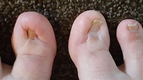 Can I have nail varnish on my toes for surgery?