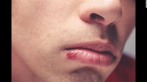 Can I kiss my boyfriend if he has a cold sore?
