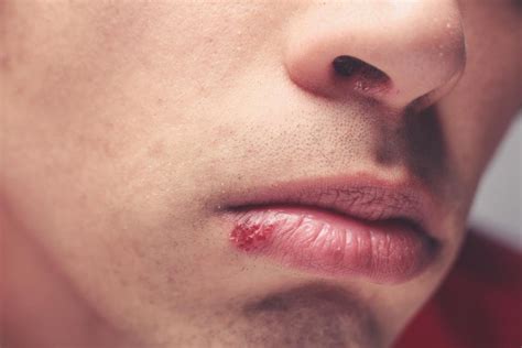 Can I kiss my boyfriend if we both have cold sores?