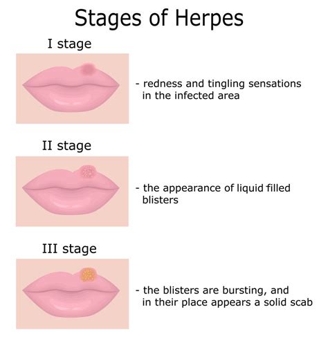 Can I kiss my girlfriend with HSV-1?