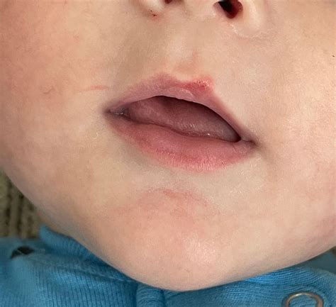 Can I kiss my own baby if I have a cold sore?