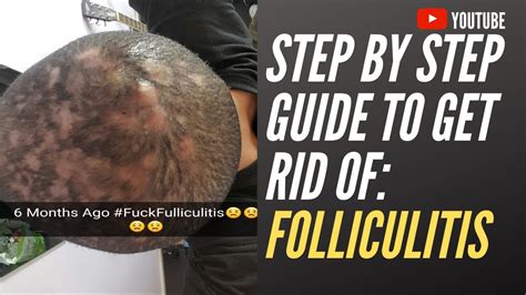 Can I leave folliculitis alone?