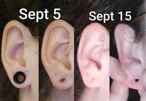 Can I let my stretched ear close?