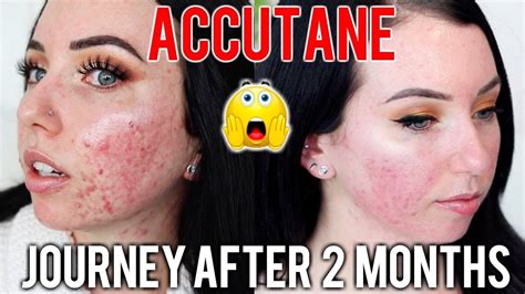 Can I lift weights on Accutane?