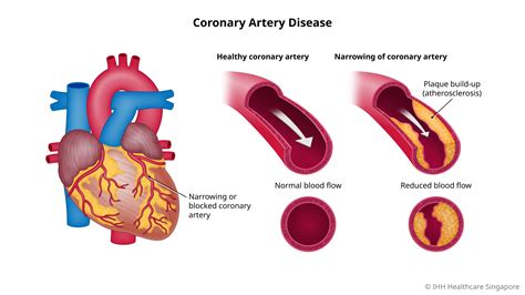 Can I live a long life with coronary artery disease?