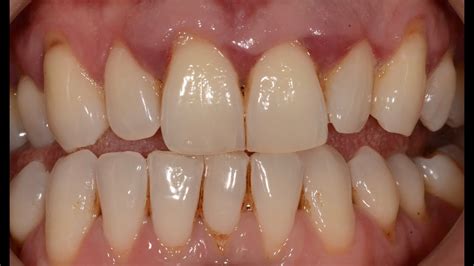 Can I live a normal life with periodontitis?