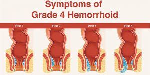 Can I live with Grade 4 hemorrhoids?