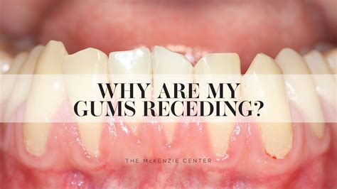 Can I live with receding gums?
