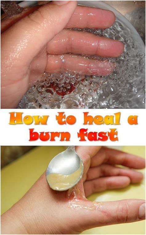 Can I make a burn heal faster?