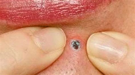 Can I pop a black pimple?