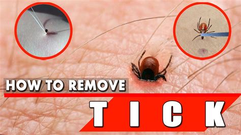 Can I pull a tick out with my fingers?