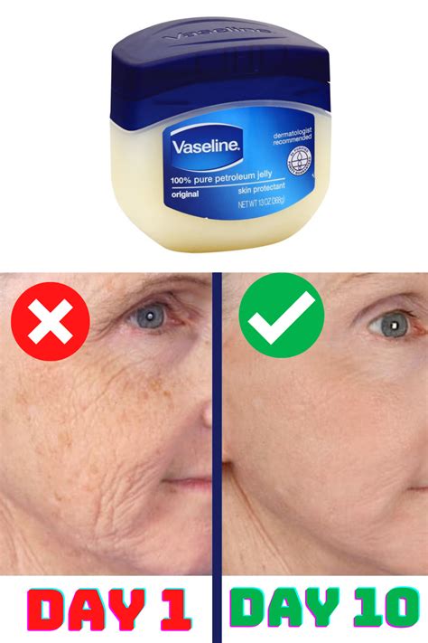 Can I put Vaseline on my face after Botox?