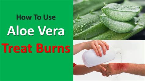 Can I put aloe vera on a burn?