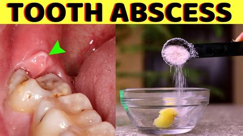 Can I put salt directly on a gum abscess?