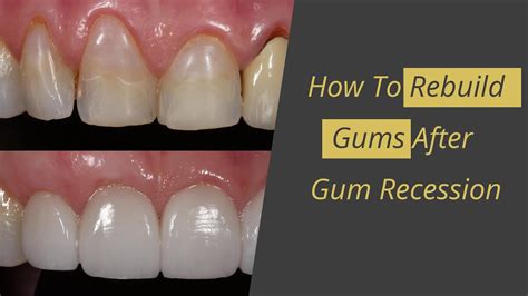 Can I rebuild my gums?