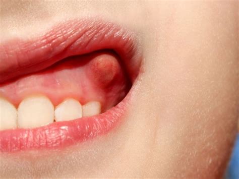 Can I remove an oral fibroma myself?