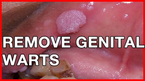 Can I remove genital warts myself?