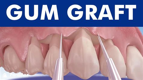 Can I remove gum flap at home?