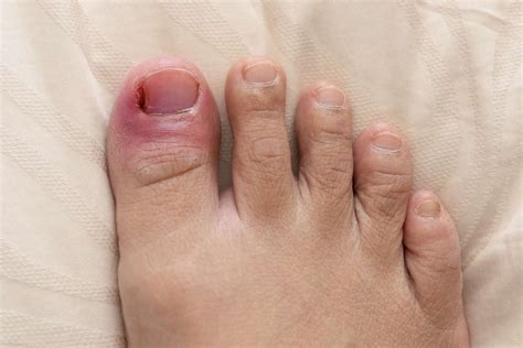 Can I reset my own toe?