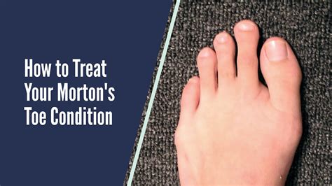 Can I run with Morton's toe?