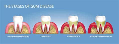 Can I save my teeth if I have periodontitis?