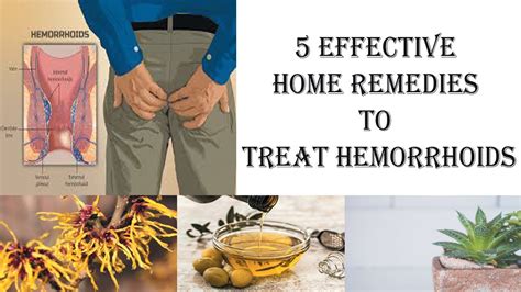 Can I self treat hemorrhoids?