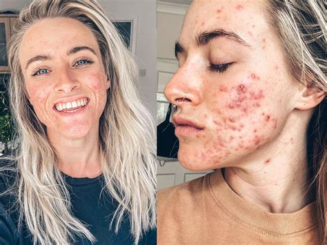 Can I still be pretty with acne?