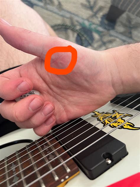 Can I still play guitar with blisters?