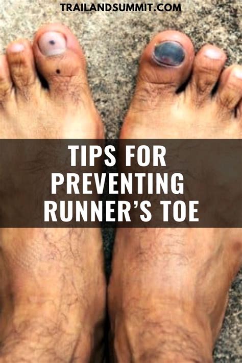 Can I still run if I lose a toenail?