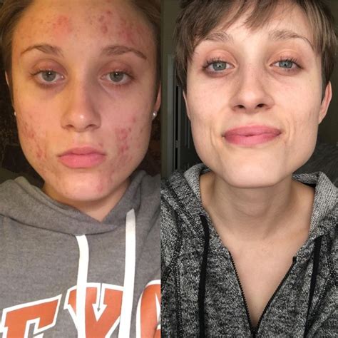 Can I stop Accutane after 5 months?